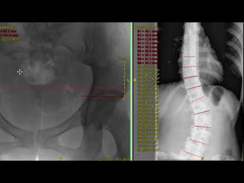 La osteocondrosis la faringitis los síntomas