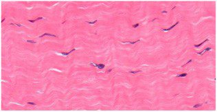 tendinosis