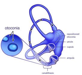 Diagrama BPPV | El Quiropráctico El Paso, TX