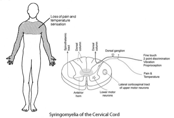 Cape and Shawl Pattern of Neuropathy | El Paso, TX Chiropractor
