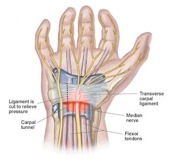 Carpal Tunnel Syndrome | El Paso, TX Chiropractor