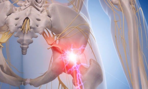 Understanding the Facts About Sciatica in El Paso, TX