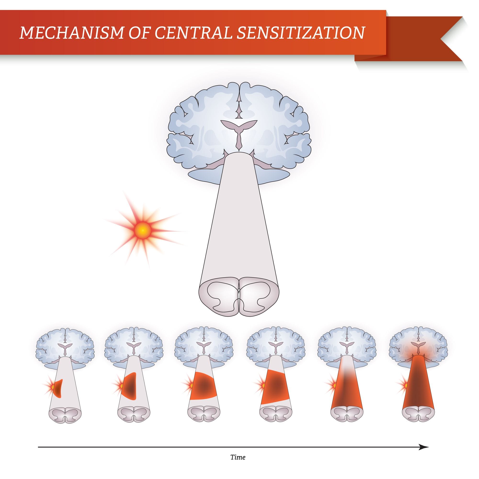 Mechanism of Central Sensitization | El Paso, TX Chiropractor