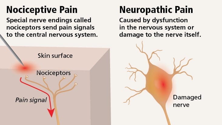 visualizes difference between nociceptive pain and neuropathic pain