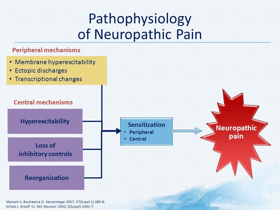 Fisiopatología del diagrama del dolor neuropático | El Quiropráctico El Paso, TX