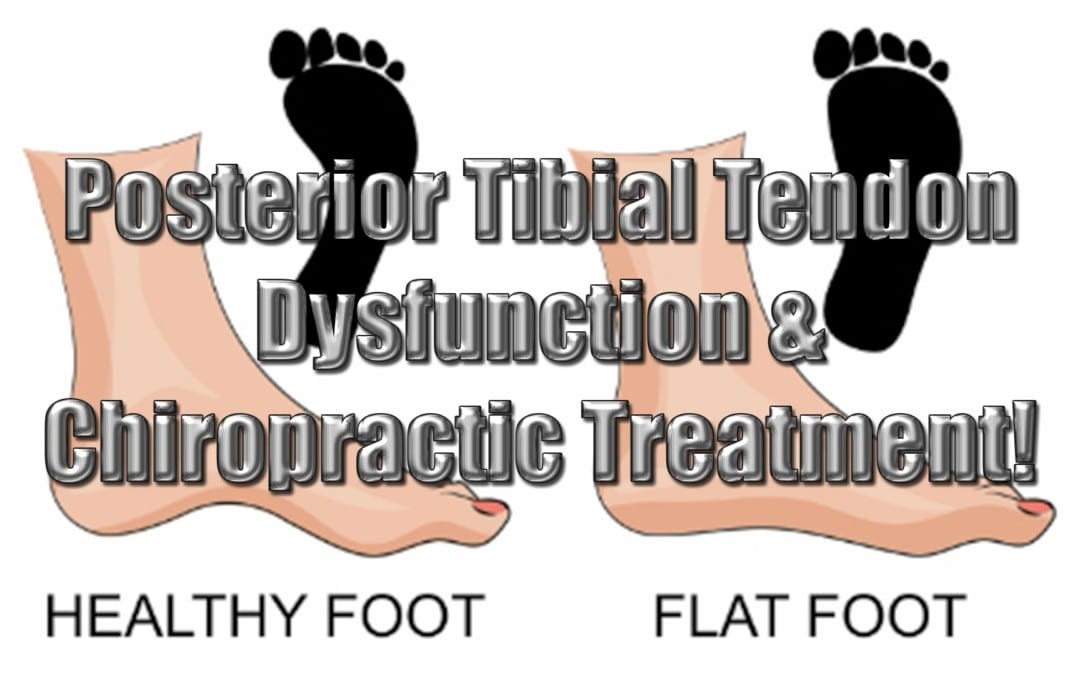 Posterior Tibial Tendon Dysfunction And Chiropractic