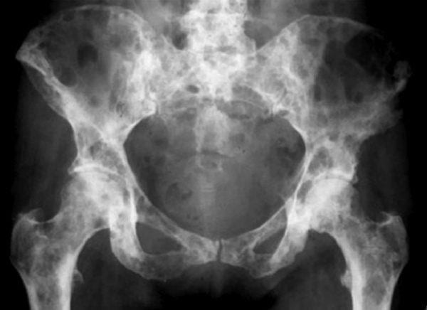 What is Metastatic Bone Disease?