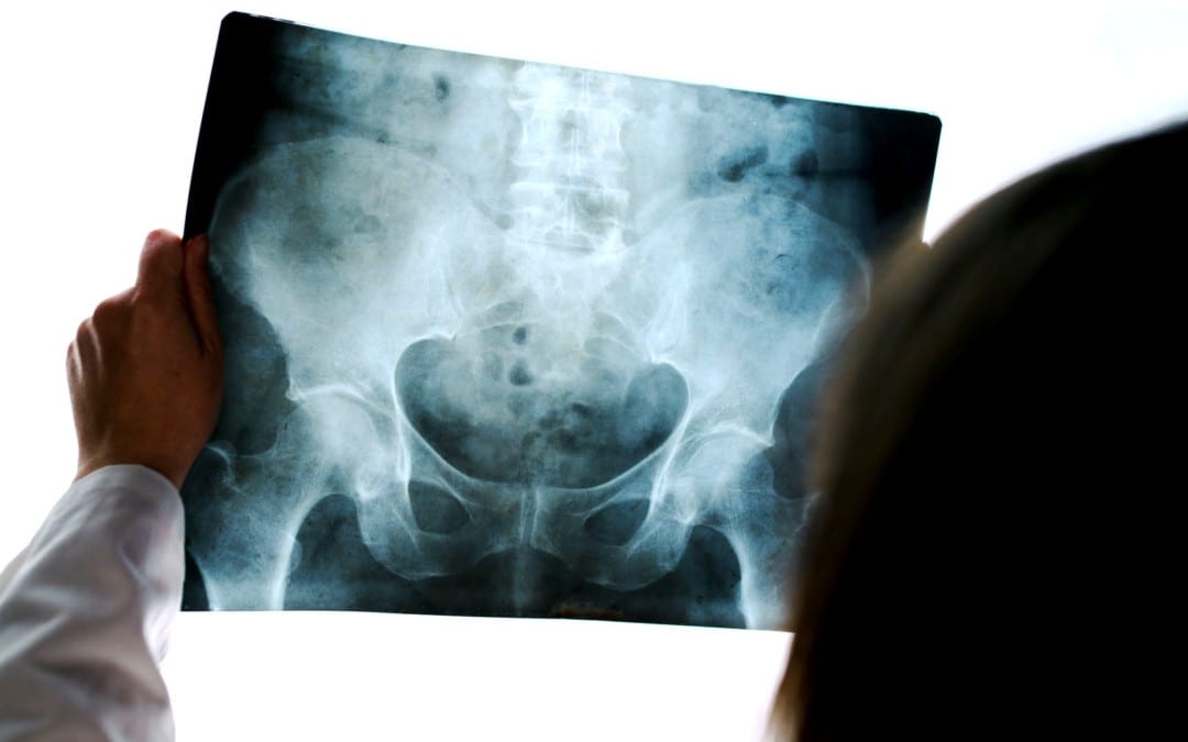 Acute Pelvis & Hip Trauma Imaging Diagnosis Part II | El Paso, TX.