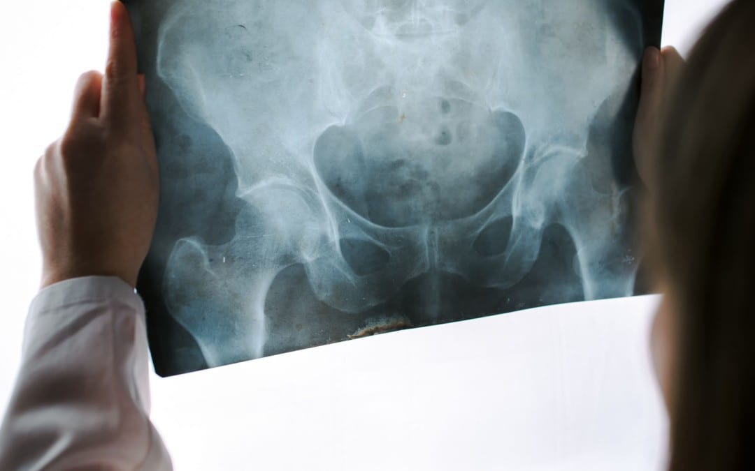 Diagnosis of Hip Complaints: Arthritis & Neoplasms Part I | El Paso, TX.
