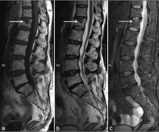 Vertebral Fracture Diagnosis Imaging Studies