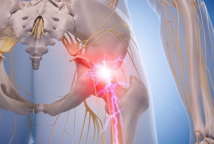 Piriformis Syndrome Management