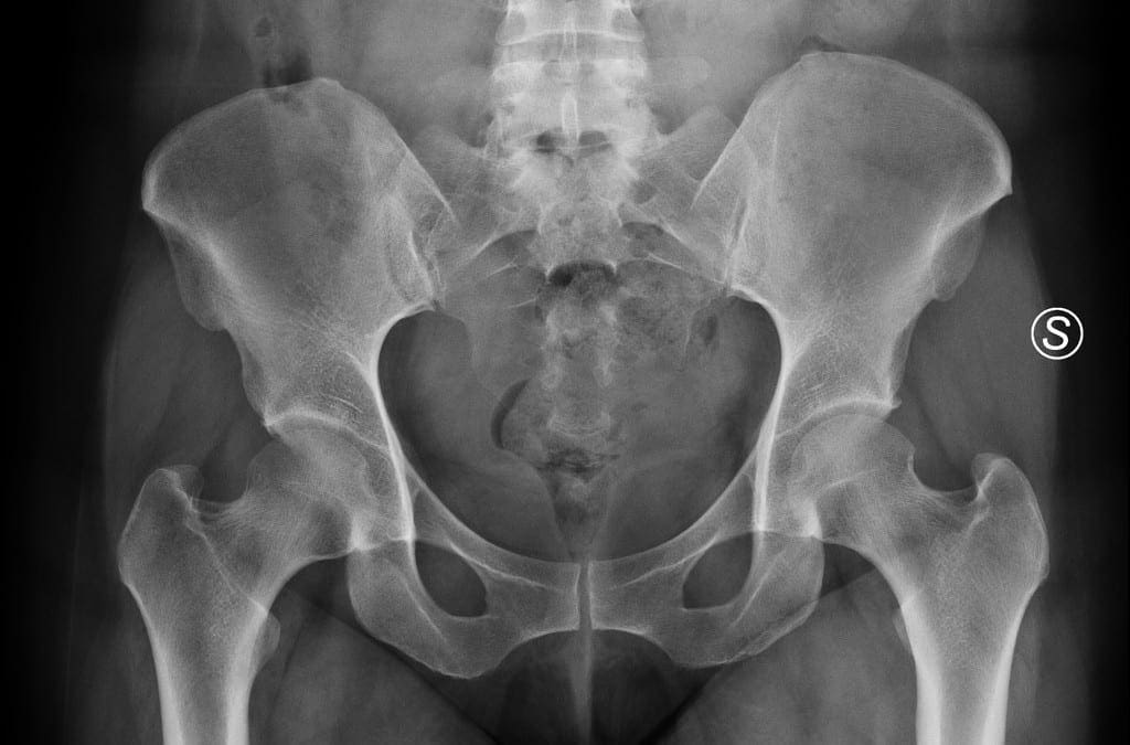 Tratamiento de osteitis pubis