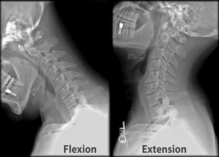 Rheumatoid Arthritis of the Cervical Spine
