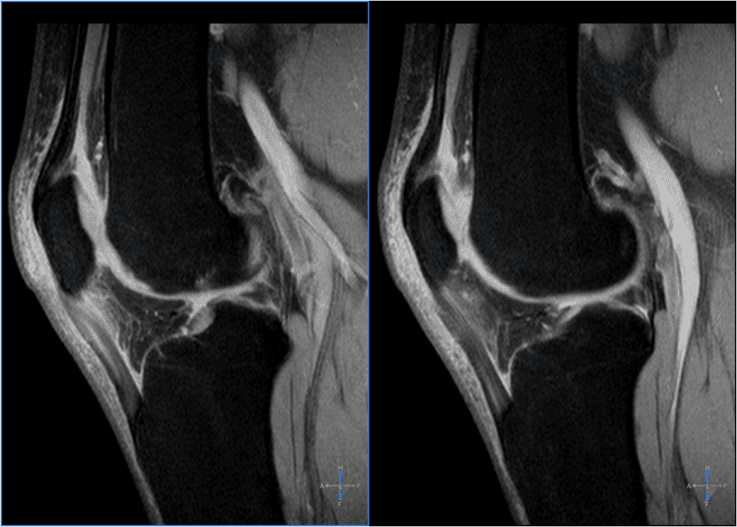¿Qué es la tendinitis patelar?