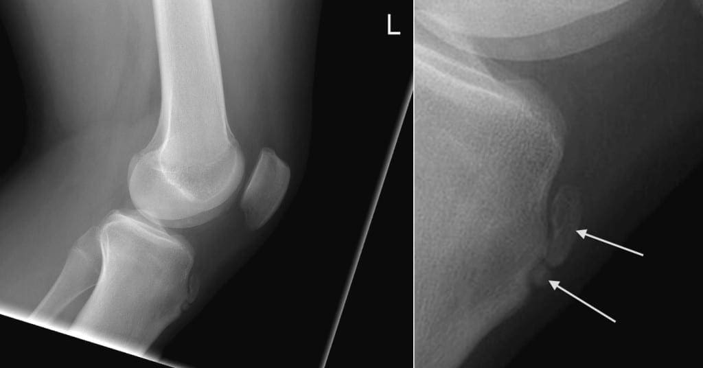 ¿Qué es la enfermedad de Osgood-Schlatter?