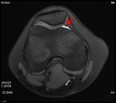 ¿Qué es el síndrome de Plica de rodilla?