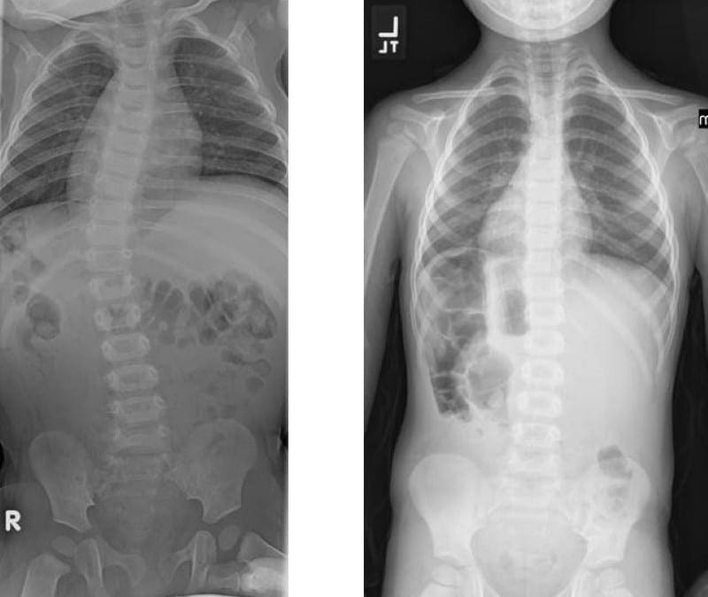 Scoliosis Clinical Presentation