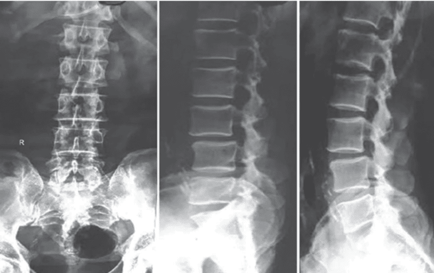 Classifying Spondylolisthesis