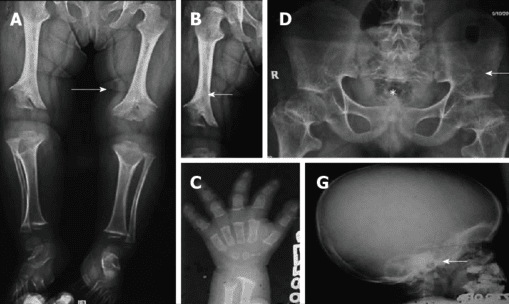 Achondroplasia Clinical Presentation